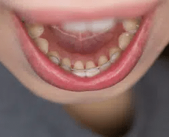 Close-up of a patient's smile showing natural teeth with slight discoloration before dental treatment.