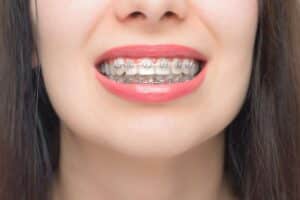 Young woman displaying metal braces on upper and lower teeth with pink lipstick.