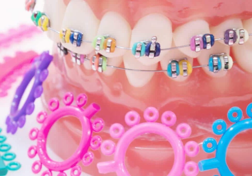 orthodontic model and dentist tool - demonstration teeth model of varities of orthodontic bracket or brace